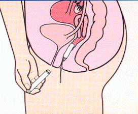 Les protections féminines (règles chez les filles, tampons, serviettes  hygiéniques) ~ Pediatre Online